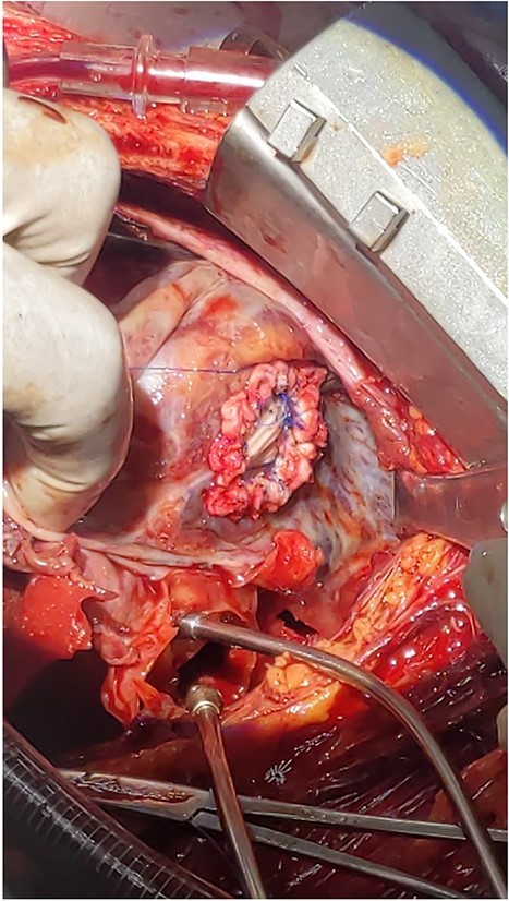 Intraoperative picture of a 2 cm rupture of left ventricle repaired with Dacron patch.