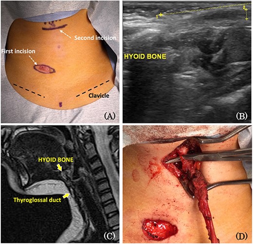 (A) The opening with the exudate was located in the caudal side of the thyroid cartilage and the right of the midline. Stepladder incision; the first skin incision was made to cut through the opening in a spindle shape, and the second incision was made in the skin just above the hyoid bone. (B) Ultrasonography showing a continuous cord-like echogenic image from the opening to the bottom of the hyoid bone. (C) MRI scan showing a continuous high-signal area from the opening with the exudate to the hyoid bone on T2-weighted images. (D) The sinus tract was pulled out from the first incision and was traced to the foramen caecum, which included en bloc removal of the central position of the hyoid bone.