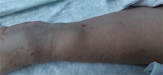 Pulsatile and expandable mass in the left wrist.