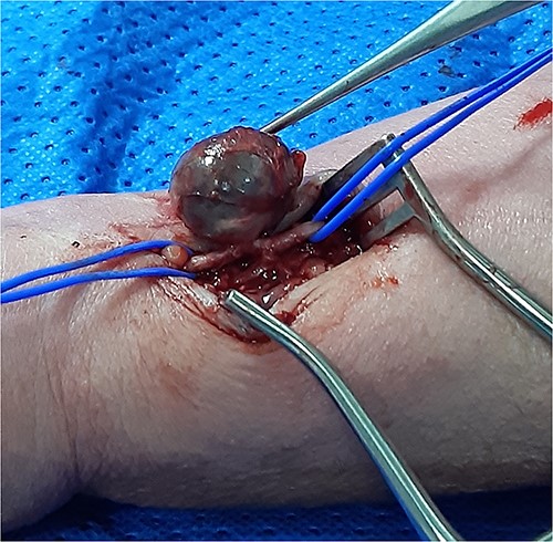 Isolation of the radial artery with the PA.
