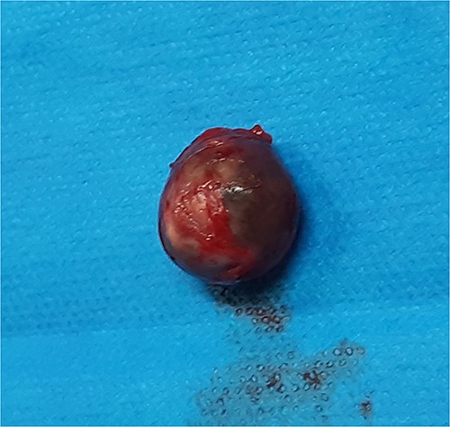 Resected PA.