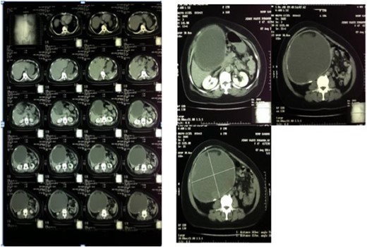 Abdominal CT-scan showed homogenous cystic mass surrounded with a regular wall (left). A cystic mass below the liver expanded to the right lower quadrant of the abdomen (right).