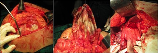 Intraoperative findings showed a balloon-shaped cystic mass surrounded by omentum and adherent to surrounding tissues. (A) A cystic mass was surrounded by omentum, (B) The cystic mass had been dissected from the mesentery and surrounding tissue and found out to be a GGB. (C) The cystic mass appears on the inferior surface of the liver, where the gallbladder’s anatomical position should be.