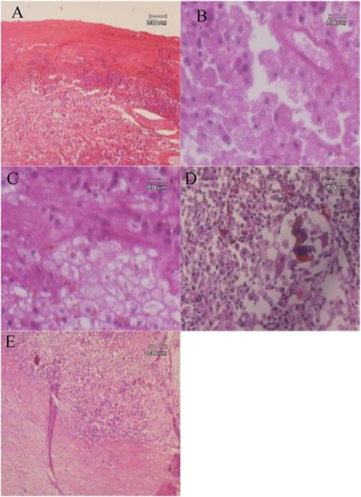 Histopathology examination of GGB: (A) The cyst wall consists of fibrous tissue infiltrated by inflammatory cells; (B) macrophage foamy cells; (C, D) foamy macrophages and brown pigments; (E) Fibrous tissue with infiltration of mononuclear inflammatory cells.