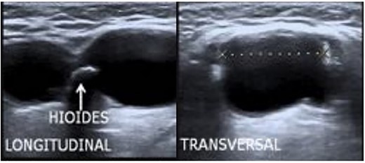 Ultrasound of the submandibular mass.