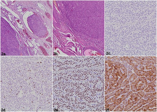 Microscopic images of the histopathological examination. (a) Vascular invasion (Hematoxylin &eosin staining). (b) Solid and trabecular tumor growth pattern (Hematoxylin & eosin staining). (c) Negative immunohistochemistry staining for Synaptophysin. (d) Nuclear instead of membrane immunohistochemistry expression for Ki-67 (MIB-1). (e) Nuclear positivity for the immunohistochemical marker TTF-1. (f) Cytoplasmic staining for the immunohistochemistry marker CK7.