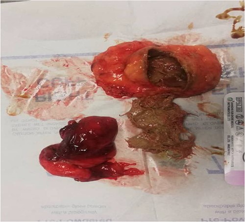 The four by four surgical gauze after removal from patient’s inguinal canal.