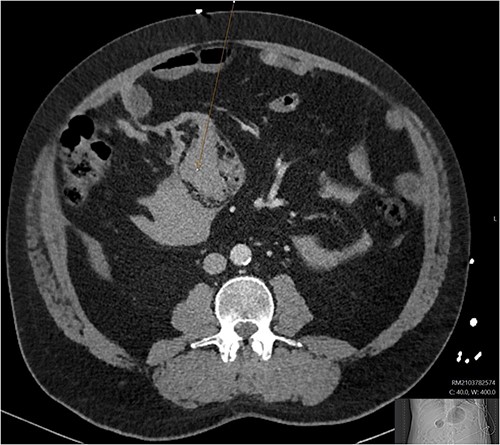 CT angiogram showing a large acute mesenteric haematoma. Figure 1 is taken from an axial section of the patient’s initial CT angiogram of the abdomen and pelvis. The arrow shown highlights an area of high-density fluid representing a 104 x 62 mm acute mesenteric haematoma.