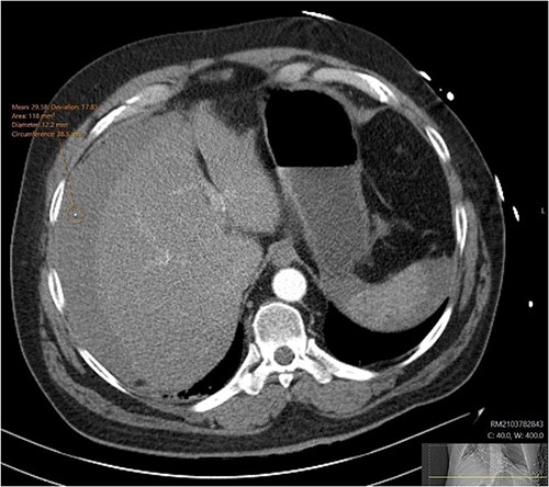 CT angiogram showing a peri-hepatic haematoma. Figure 2 is an axial section taken from the patient’s initial CT angiogram of the abdomen and pelvis. A large crescent shaped peri-hepatic haematoma is highlighted by the arrow displayed.