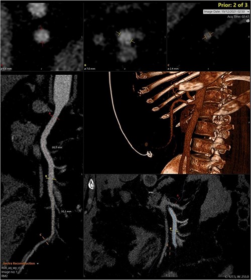 Curved reprogramming of the initial CT angiogram. Curved reprogramming of the patient’s initial CT angiogram showed no evidence of an aneurysm within the superior mesenteric artery, effectively ruling this out as a cause of the patient’s acute bleed.