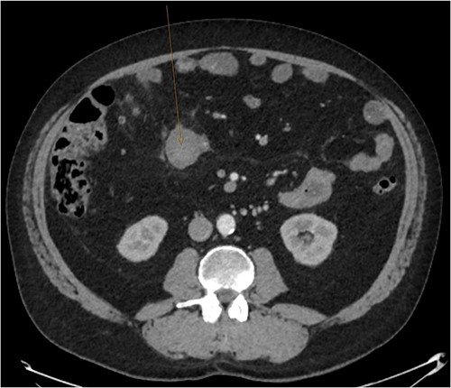 Follow up CT angiogram showing improvement in mesenteric haematoma. Figure 4 is an axial section from the patient’s CT scan performed 4 weeks following discharge. The arrow highlights the patient’s liquefying mesenteric haematoma, which decreased from 104 x 62 mm to 60 x 40 mm. Combined with the improvement in the other areas of intra-abdominal bleeding and the patient’s overall clinical state, this image represents a significant improvement.