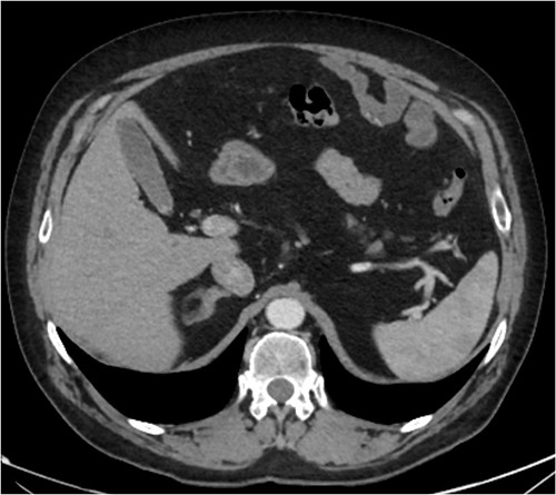 Follow up CT angiogram showing improvement in perihepatic haematoma. Figure 5 is another axial section from the patient’s CT angiogram performed 4 weeks following discharge and shows resolution of the perihepatic haematoma seen previously. Together with the other sections of the CT angiogram and the patient’s overall clinical state, the image represents a significant improvement in the patient’s intra-abdominal bleeding.
