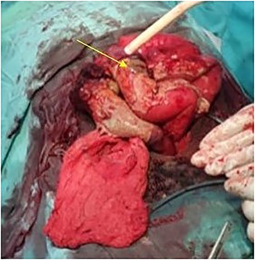 Intraoperative view showing the perforation in the ileum due to the mesenteric tumor (arrow).