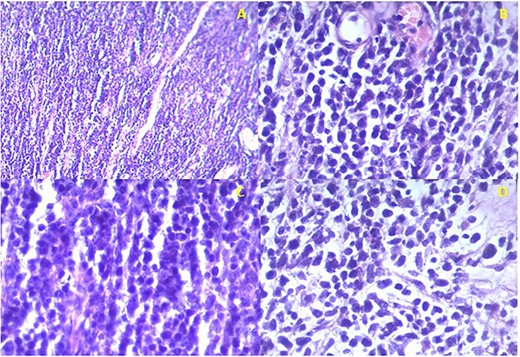 Istopathological analysis. (a) There is densely cellular tumor infiltrates without any discernable pattern. The intercellular matrix consists of sparse fibrous tissue. (b) The majority of the tumor cells appear undifferentiated with hyperchromatic oval to round nuclei with scant cytoplasm. Most of the cells are epithelioid with occasional spindle cells. (c) Occasional mitotic figures are seen. (d) Some cells have eccentric nuclei and abundant pink cytoplasm typical of rhabdomyoblasts.