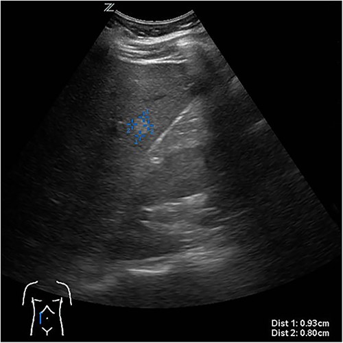 First documentation of liver cyst of the patient in ultrasound.