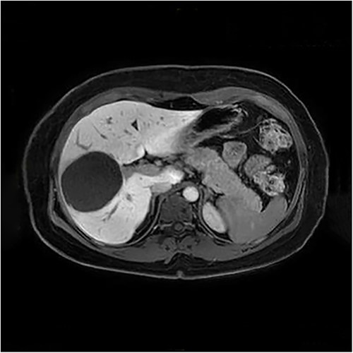 Evidence of a size-progressive septated liver cyst in the MRI.