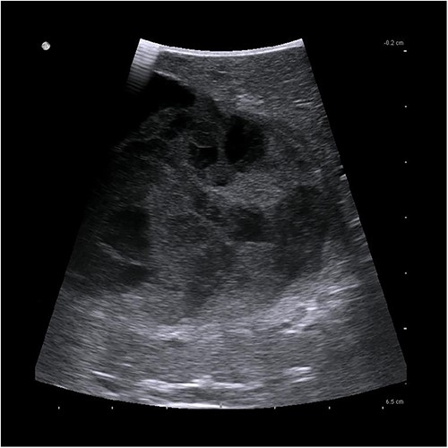 Intraoperative ultrasonographic localization of the liver cyst.