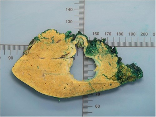 Macroskopic findings of the liver resection.