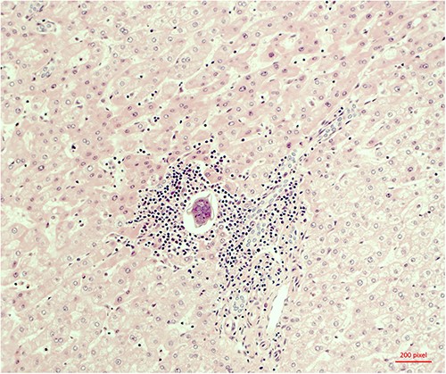 Microscopic evidence of Schistosoma mansoni.