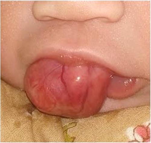 Preoperative clinical photograph showing epulis mass protruding through oral cavity.