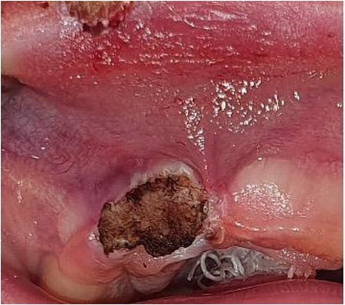 Intraoperative clinical photograph showing electrocauterization of epulis mass.
