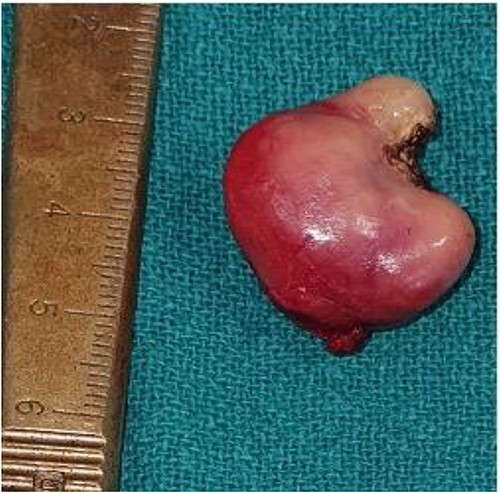 Excised epulis mass.