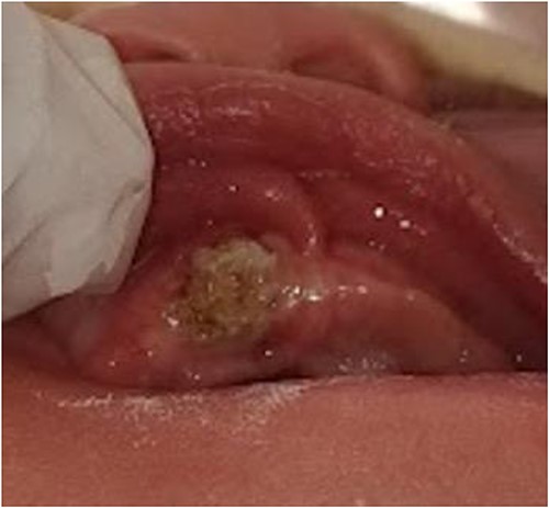 Third postoperative clinical photograph.