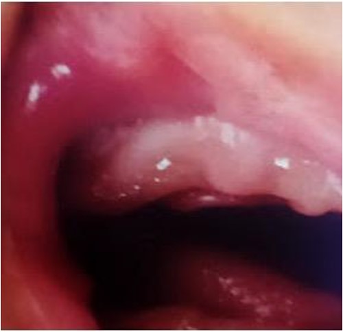 Sixth month postoperative clinical photograph.