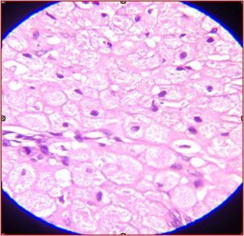 Microscopic feature of the tumor showing sheets of polygonal cells with eosinophilic granular cytoplasm (HE stains, X10).