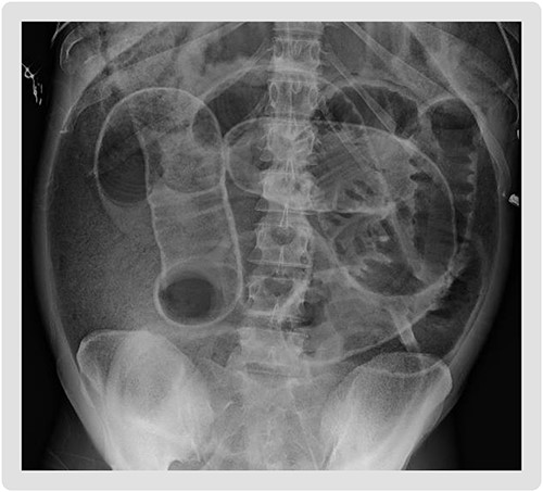 Supine abdominal plain film on admission demonstrating Rigler’s sign, bowel loops outlined by air, increasing suspicion for large volume pneumoperitoneum.