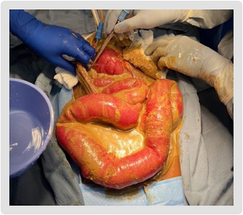 Diffuse feculent peritoneal contamination seen upon entering the abdomen.