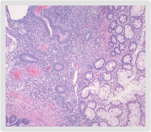 Endometrial mucosa (left) with intestinal glands from the large bowel (right).