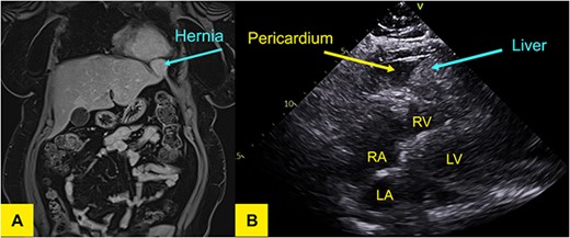 (A) T1-weighted MR of the liver in coronal plane showing a wide neck hernia at the anterolateral aspect of left hemidiaphragm that contains liver tissue and bulges outside the liver contour. No signal/enhancement abnormality. (B) Transthoracic echocardiogram demonstrating liver in pericardium adjacent to left ventricle.