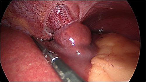Intraoperative photo of portion of Segment 2 of the liver herniating through defect in central tendon of diaphragm and into pericardial sac. Pericardial adhesions are connected to the capsule of liver.
