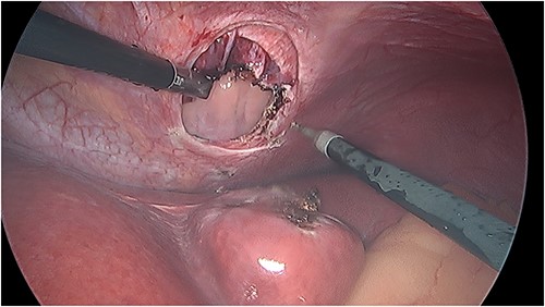 Intraoperative photo demonstrating the defect in the central tendon of the diaphragm into the pericardium after the liver had been reduced. The liver appeared viable on inspection.