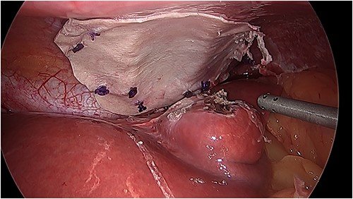 Intraoperative photo of the repair with bovine pericardial tissue.