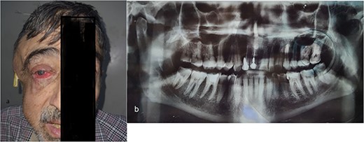 (a) The right masticatory, buccal and temporal regions are markedly swollen, and a drain has been inserted into the abscess cavity in temporal region. There is obvious pus oozing from the right eye, and the right eyelid and cornea both exhibit redness and edema. (b) Panoramic radiograph revealed periapical abscess, lateral large deep caries with pulp involvement in the third right mandibular molar tooth.