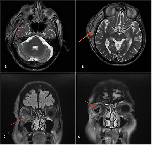 (a) Axial MRI of the head: a dumbbell-shaped lesion (red arrows) representing an infratemporal abscess invading the orbital cavity through the bony erosion of the lateral orbital wall. (b) Abscess localization in the deep temporal space (red arrows). (c, d) Coronal MRI of the head and neck shows an orbital abscess (red arrows) and endopthalmitis (red arrows).