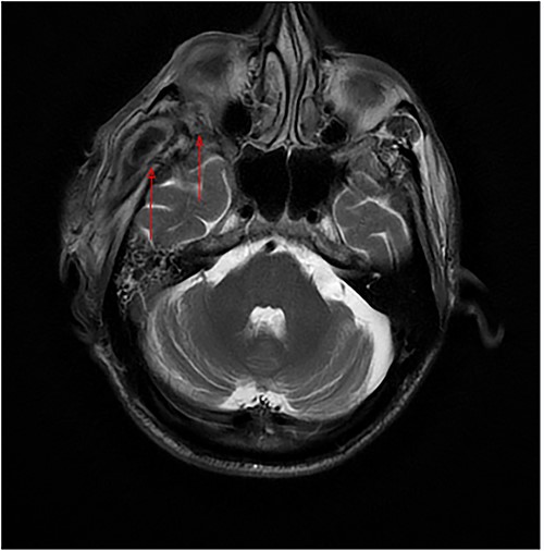 Axial MRI of the head, a dumbbell-shaped lesion (red arrows) representing an infratemporal abscess invading the orbital cavity through the bony erosion of the lateral orbital wall.