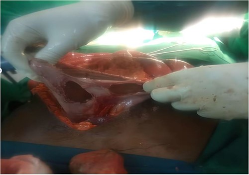Gastric blast occurred intraoperative due explosion after gas–diathermy reaction.