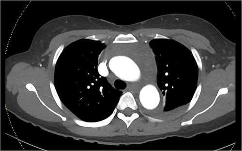 CTPA imaging demonstrating aortic hyper-density.