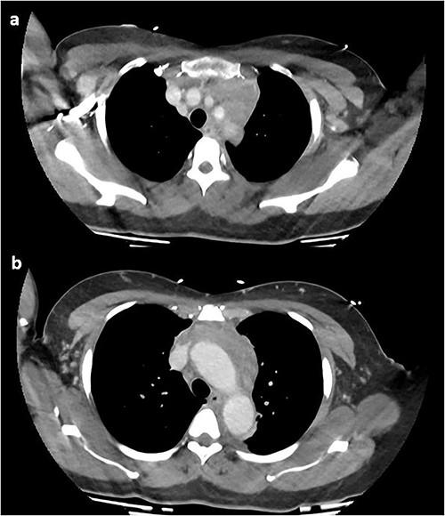 CT chest with contrast demonstrating anterior mediastinal soft tissue density in the (a) upper chest and (b) lower chest.