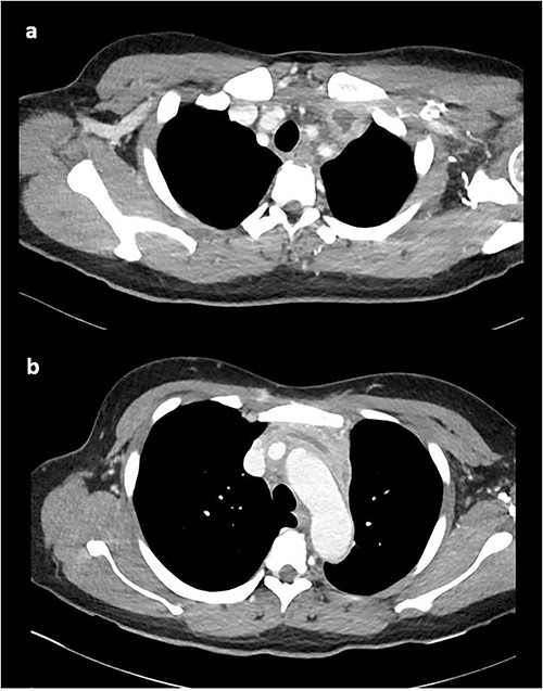 CT venogram demonstrating UEDVT in left brachiocephalic vein in the (a) upper chest and (b) lower chest.