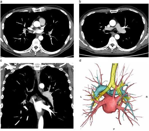 CT images. (a, b: axial images, c: coronal image, d: 3D image). The vessel was observed arising from the PVs draining the posterior upper lobe, running posterior to the RMB, and draining into the LA.