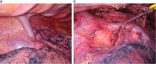Surgical findings. (a) A large-caliber, anomalous PV was running posterior to the RMB. (b) After LND: the anomalous vessel is draining into the LA.