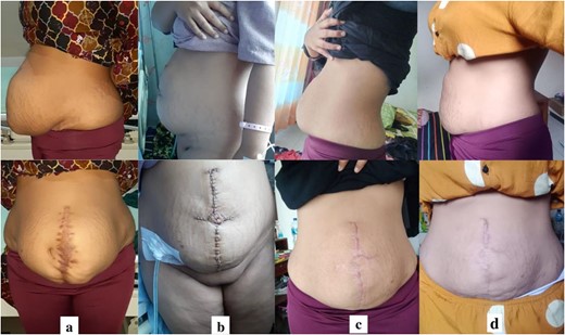 (a) Preoperative images; (b) postoperative images; (c) 3-month follow-up images; (d) 1 year’s follow-up images.