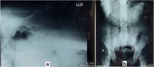(a) Left lateral decubitus (LLD) abdominal X-ray; (b) supine abdominal X-ray.