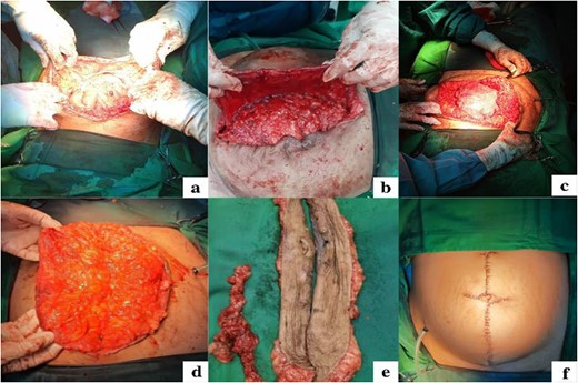 Intraoperative images. (a) Exploration and adhesiolysis release adhesion of the omentum and the ileum; (b) Close the large defect and strengthen the abdomen wall with MPFH; (c). Polypropylene mesh insertion with sublay placement; (d-e) Excision of excess skin including the navel; (f) Abdominoplasty to create a new umbilical and closure of the entire abdomen.
