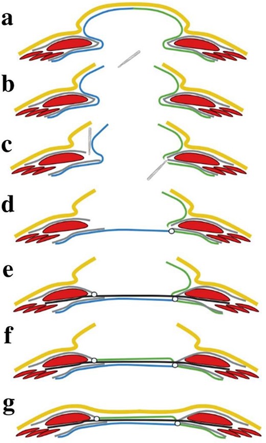 Schematic figure of MPFH technique: (a) The IH, the hernial sac left side (blue) and right side (green); (b) The skin (yellow) and the hernia sac are incised at the prior operative scar; (c) One anterior and one posterior flap are created by entering the retromuscular space through incising the left side’s anterior fascial sheath and the right side’s posterior fascial sheath; (d) The abdominal cavity is closed by suturing the posterior rectus fascia on the right side and the posterior flap. The rectus muscles are as closely approximated as possible; (e) The retromuscular mesh is placed and fixated by suture to the fascial margins. The anterior fascial sheet is sutured to the mesh as closely as possible to the midline; (f) The mesh is covered with the anterior flap which is sutured to the fascial margin on the left side; (g) Closure of the skin and subcutaneous tissue.