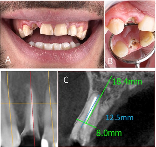 (A) Preoperative frontal view, (B) preoperative occlusal view, (C) preoperative CBCT.